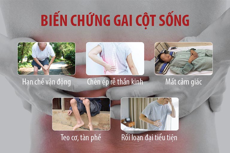 Các biến chứng nguy hiểm cần tránh của bệnh gai cột sống