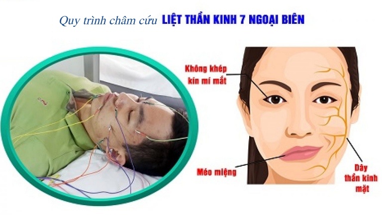 Quy trình thực hiện châm cứu liệt 7 ngoại biên.  