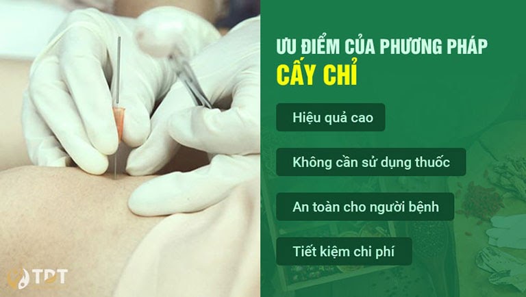 Cấy chỉ là phương pháp điều trị hen suyễn hiệu quả, phòng tránh tái phát bệnh tốt nhất