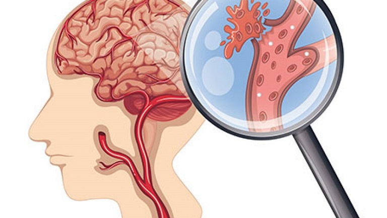 Đột quỵ: Triệu chứng, nguyên nhân và biện pháp phục hồi chức năng an toàn hiệu qu