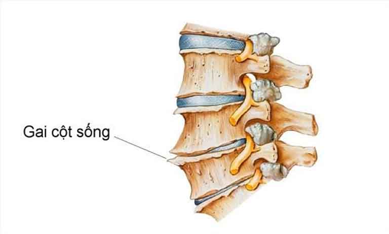 Hình minh họa gai cột sống