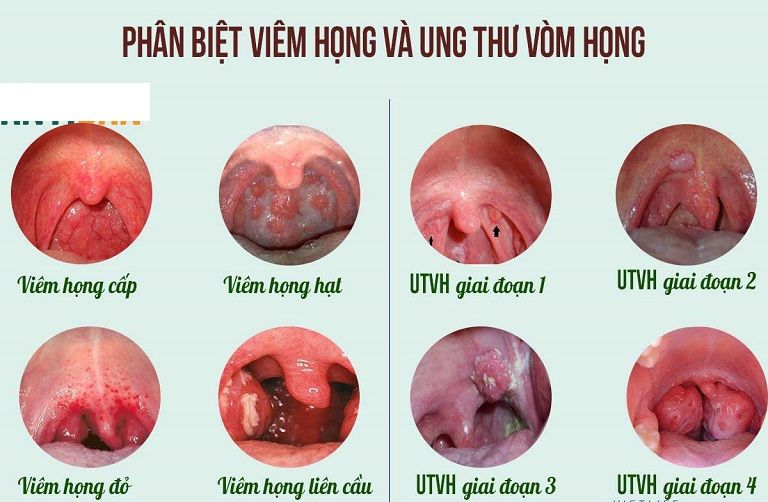 Cần phân biệt bệnh với ung thư vòm họng