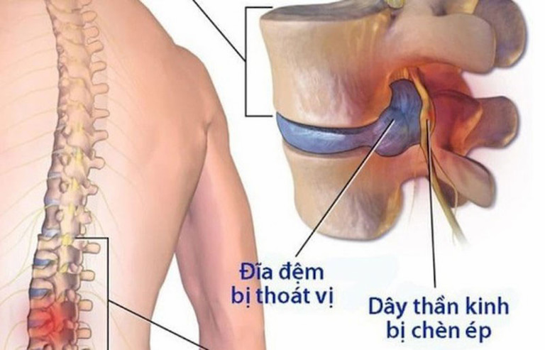 Thoát vị đĩa đệm