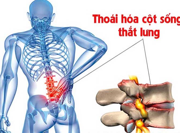 Thoái hóa cột sống là một trong những nguyên nhân phổ biến gây ra đau nhức xương sống lưng