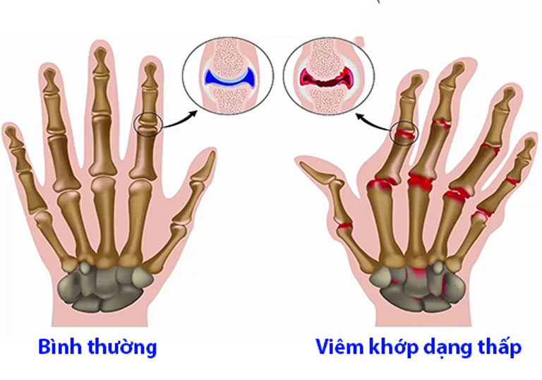 Viêm khớp dạng thấp là bệnh mãn tính tự miễn nhiều bệnh nhân gặp phải