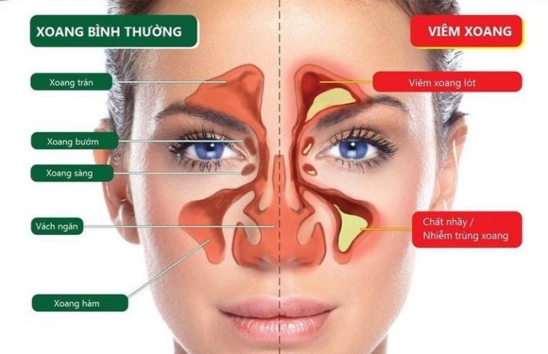 Viêm xoang là căn bệnh nguy hiểm không thể coi thường