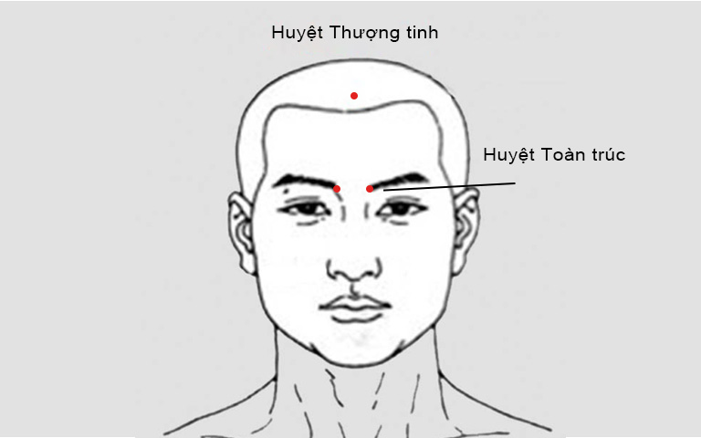 Huyệt Thượng tinh và Toàn trúc trị ngạt mũi