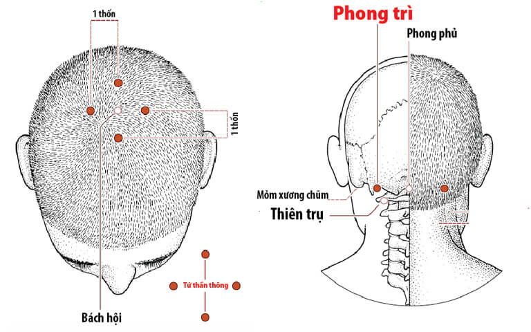 Các huyệt trị tai biến vùng đầu cổ