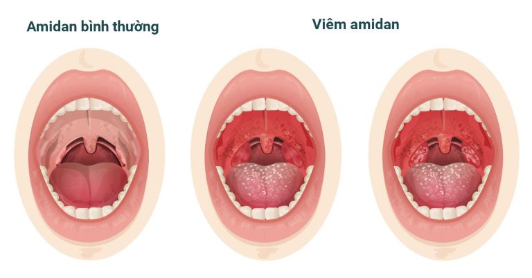 Xoa bóp bấm huyệt là biện pháp rất hiệu quả để cải thiện các triệu chứng viêm amidan