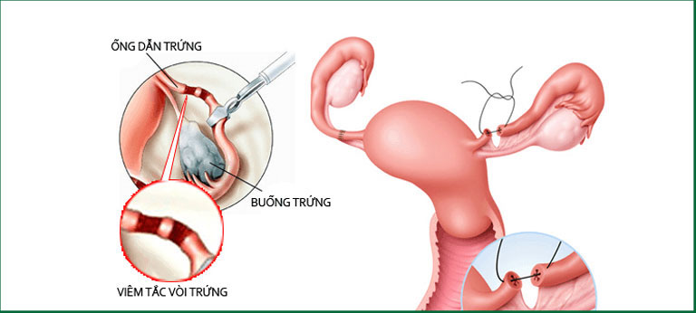 Nhiều nguyên nhân dẫn đến vô sinh ở nữ giới