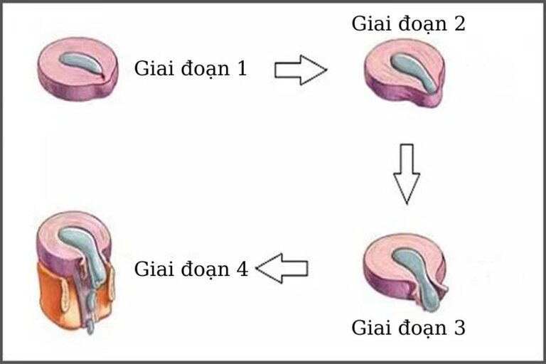 Các giai đoạn thoát vị đĩa đệm hiện nay 