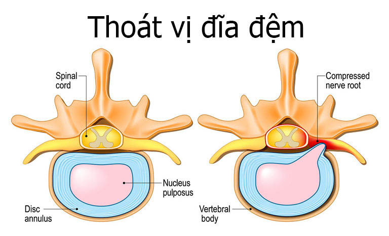 Thoát vị đĩa đệm sẽ có dấu hiệu đầu tiên là đau lưng sau phổi