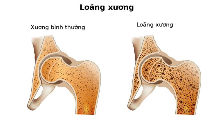 Loãng xương là một trong những bệnh lý xương khớp thường gặp nhất ở người cao tuổi