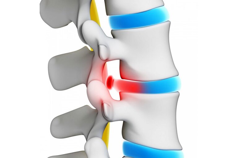 Vật lý trị liệu là một trong các cách chữa thoát vị đĩa đệm cột sống cổ được nhiều người áp dụng