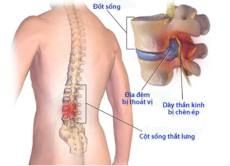 Cột sống thắt lưng là vị trí thoát vị đĩa đệm thường gặp nhất