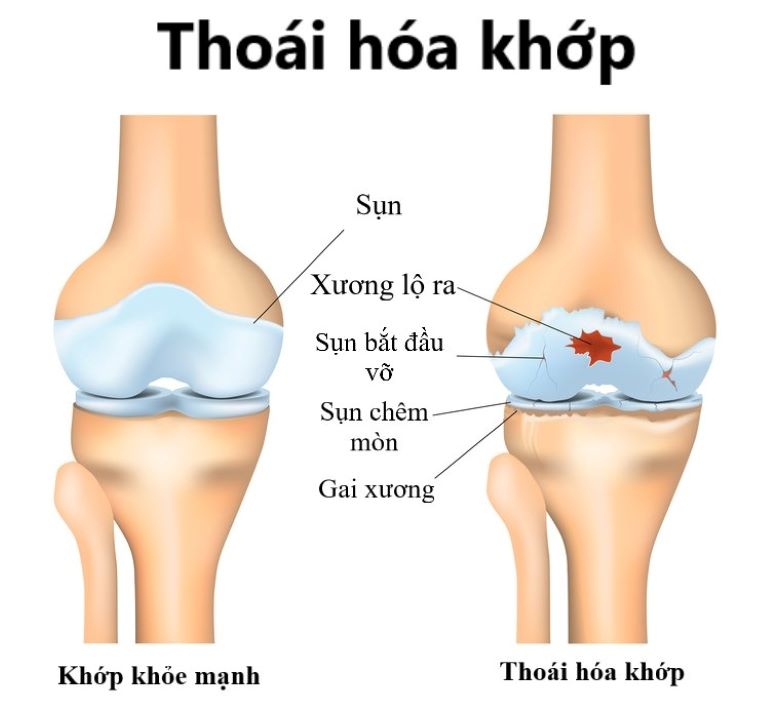 Thoái hóa khớp là nguyên nhân hàng đầu gây đau nhức xương khớp toàn thân