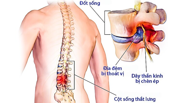 Đĩa đệm nằm giữa 2 đốt sống L4 L5 thoát ra bên ngoài theo vết nứt rách của bao xơ, chèn ép vào các dây thần kinh sống và ống sống