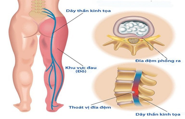 Dây thần kinh bị thương tổn khi mắc thoát vị đĩa đệm cột sống thắt lưng