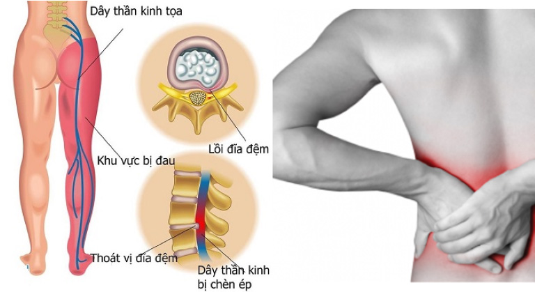 Thoát vị đĩa đệm l5 s1 điển hình với các cơn đau lan tỏa ở vùng thắt lưng và mông, có thể lan xuống đùi, chân do ảnh hưởng của chèn ép dây thần kinh