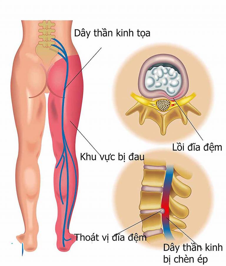 Đau vùng lưng và chân có thể do bệnh lý đau thần kinh tọa