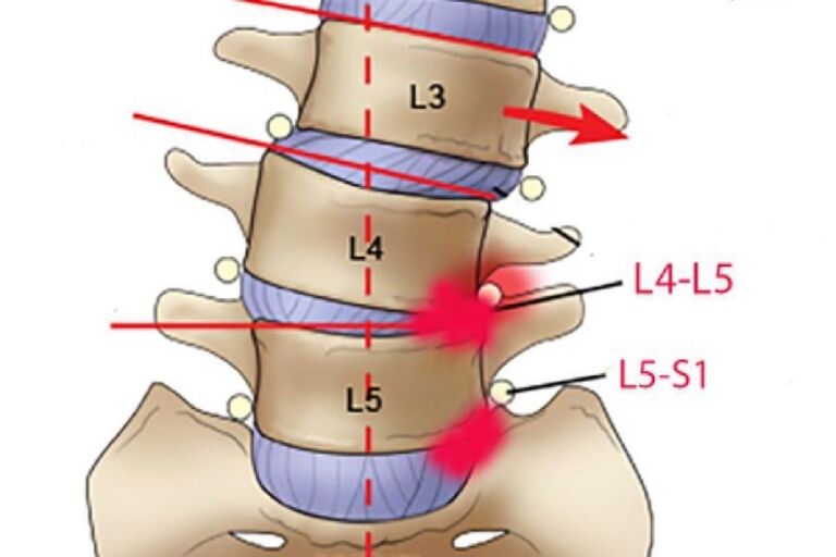 Phồng lồi đĩa đệm L5-S1 là như thế nào?