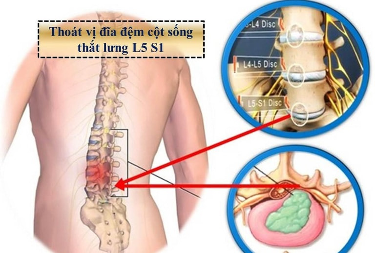 Những biến chứng nguy hiểm của bệnh phồng lồi đĩa đệm L5-S1