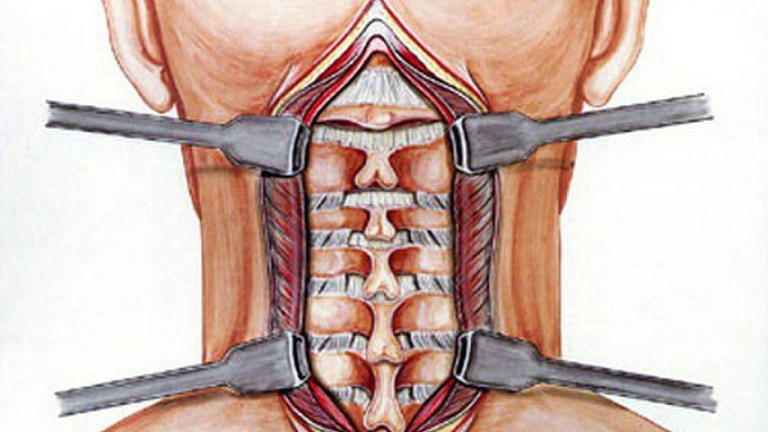 Phẫu thuật là phương pháp điều trị đau vai gáy hiệu quả nhưng tốn kém và nhiều hệ lụy