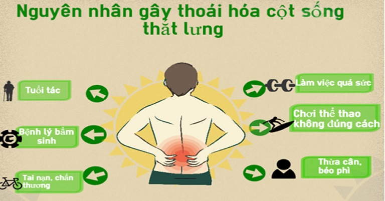 Nguyên nhân gây bệnh thoái hóa cột sống Lưng