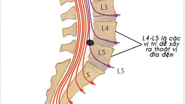 Tìm hiểu bệnh lý phồng đĩa đệm l4-l5