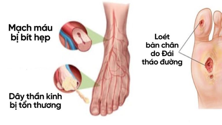 Tê bì chân tay do biến chứng bệnh tiểu đường có thể dẫn tới teo cơ, liệt hoặc xuất hiện các vết thương khó lành có nguy cơ hoại tử, phải cắt cụt chi.