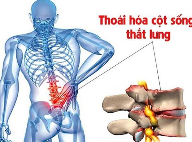 Hình minh họa thoái hóa cột sống lưng