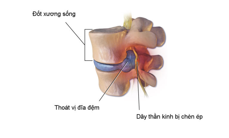 Thoát vị đĩa đệm chèn dây thần kinh là gì?