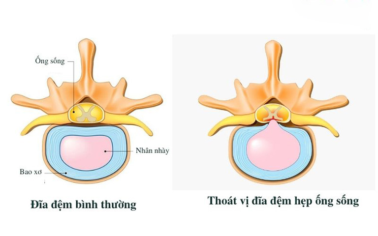 Hẹp ống sống là một trong những biến chứng nặng nề nhất của thoát vị đĩa đệm cổ