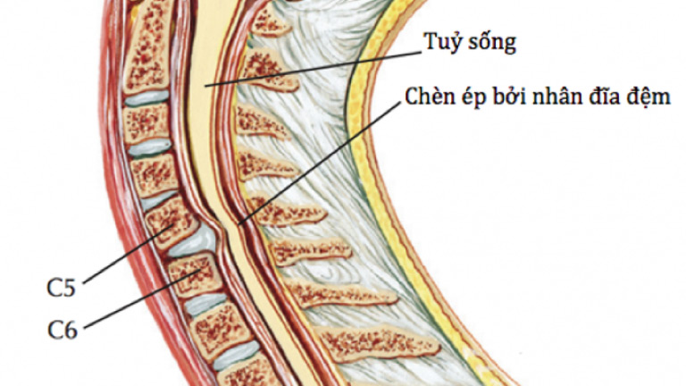 Thoát vị đĩa đệm cổ thường xảy ra nhất ở vị trí các đốt sống từ C3-C7