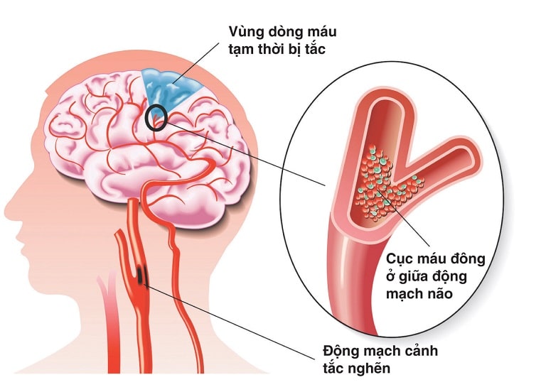 Đau đầu vùng trán do mắc các bệnh lý về mạch máu não