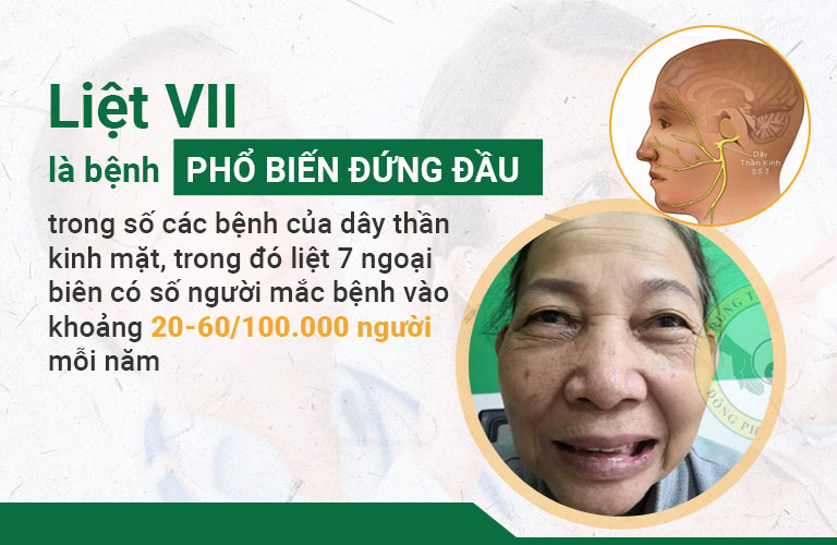 Liệt dây thần kinh số 7 là bệnh lý phổ biến