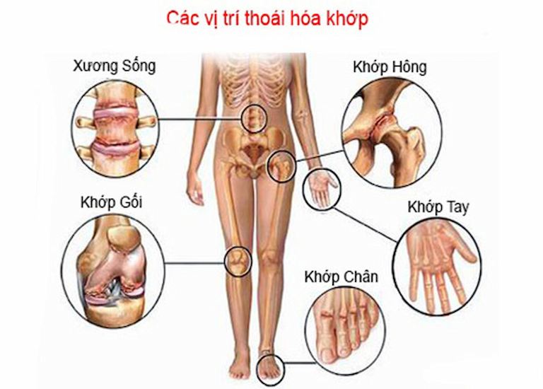 Các vị trí dễ bị thoái hóa khớp