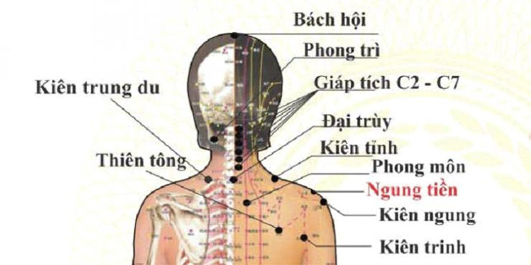 Bấm huyệt trị đau vai gáy được các chuyên gia đánh giá cao