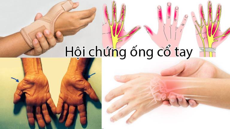 Hội chứng ống cổ tay trên cơ thể người bệnh