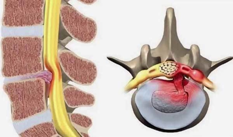 Các biến chứng nguy hiểm của bệnh thoát vị đĩa đệm