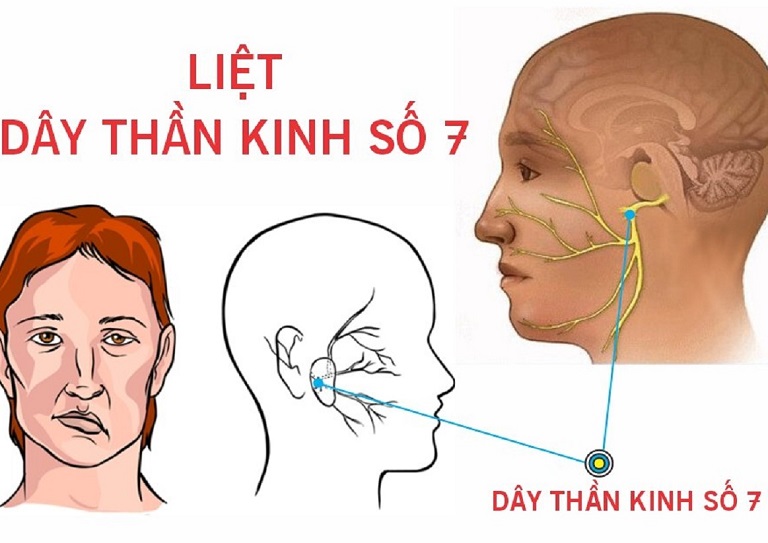 Chữa liệt dây thần kinh số 7 bằng bấm huyệt đang trở thành xu hướng