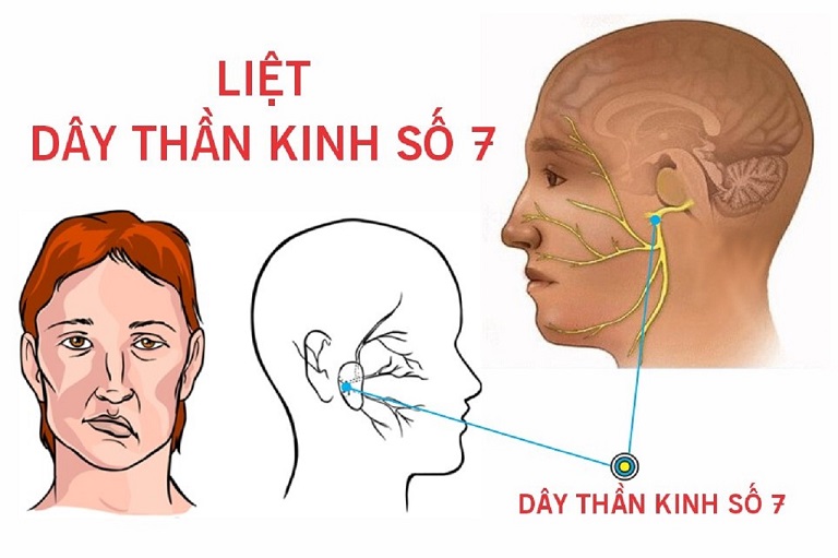 Chữa liệt dây thần kinh số 7 tại nhà cần cẩn trọng để không gây biến chứng