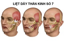 Dây Thần Kinh Số 7 Là Gì, Nằm Ở Đâu, Chi Phí Bộ Phận Nào?