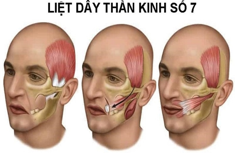 Liệt dây thần kinh số 7 ngoại biên còn được gọi là liệt mặt