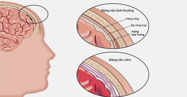 Tỷ lệ bị liệt bell là rất cao nếu người bệnh đã hoặc đang bị viêm màng não