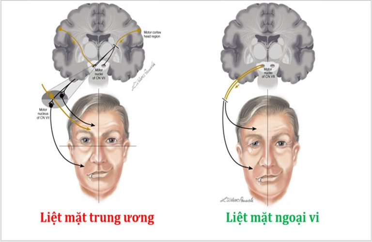 Liệt mặt trung ương khác liệt mặt ngoại biên