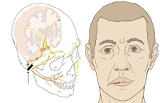 Liệt mặt trung ương: Nguyên nhân, triệu chứng, cách điều trị