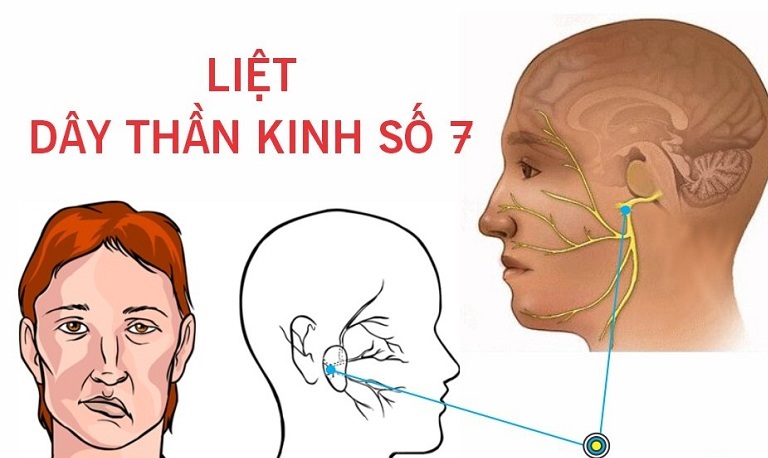 Liệt nửa mặt gây khiến người bệnh gặp không ít khó khăn trong cuộc sống