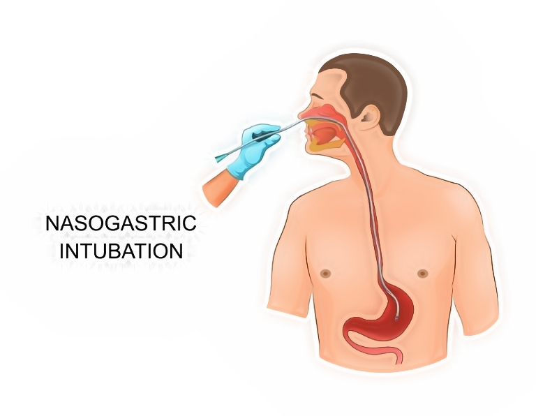 Đặt sonde dạ dày là phương pháp được chỉ định trong một số trường hợp