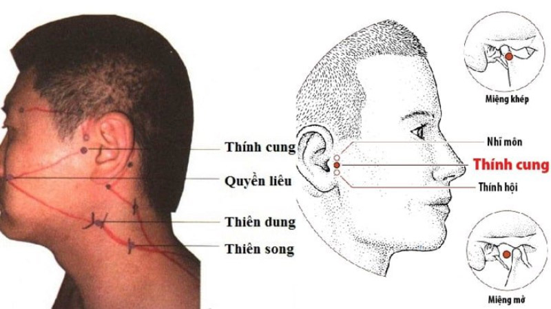 Huyệt Thính cung có ảnh hưởng rất lớn tới thính lực